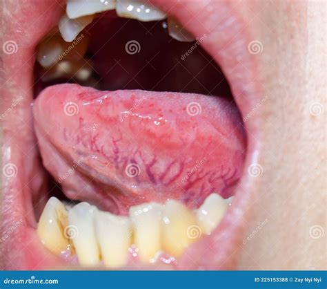 See your dentist or an ENT to make sure it is not out of the ordinary. . Enlarged veins under tongue